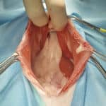peritoneoperikardiale diaphragmatische Hernie